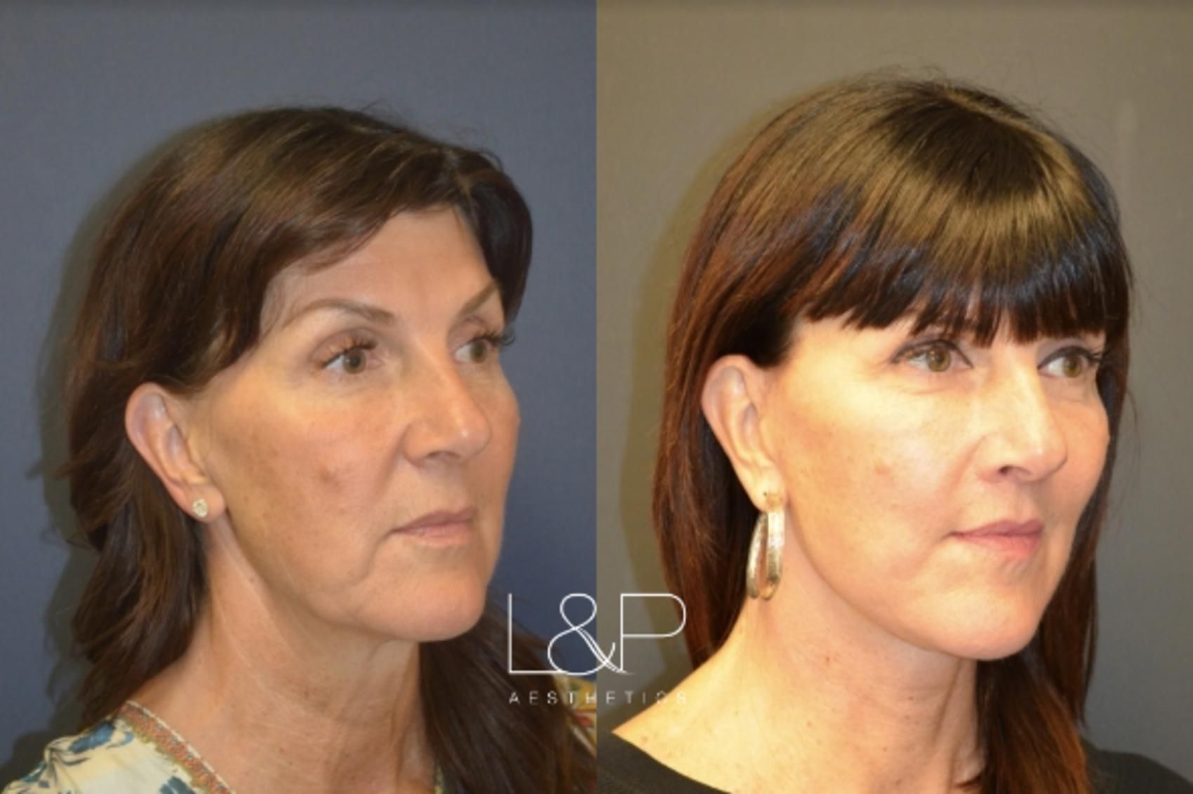 Facelift Neck Lift before and after treatment in CA