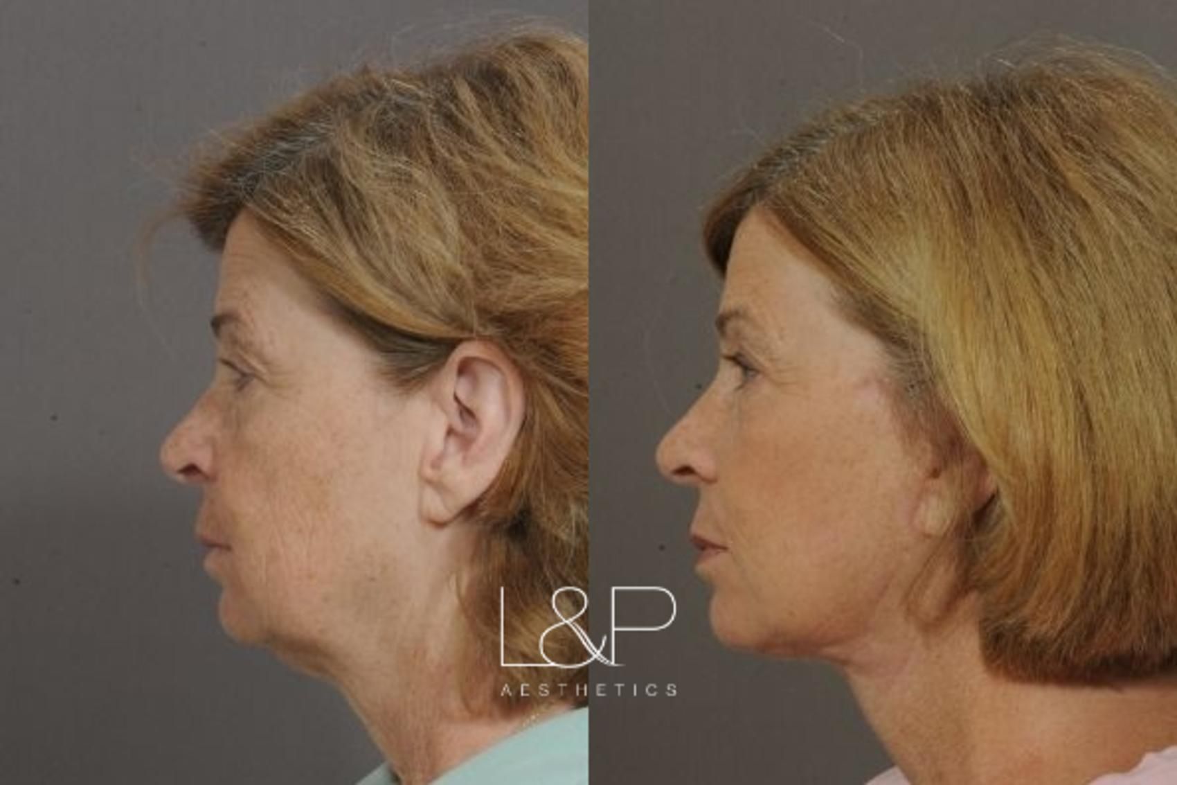 Facelift Neck Lift before and after treatment in Los Gatos, CA