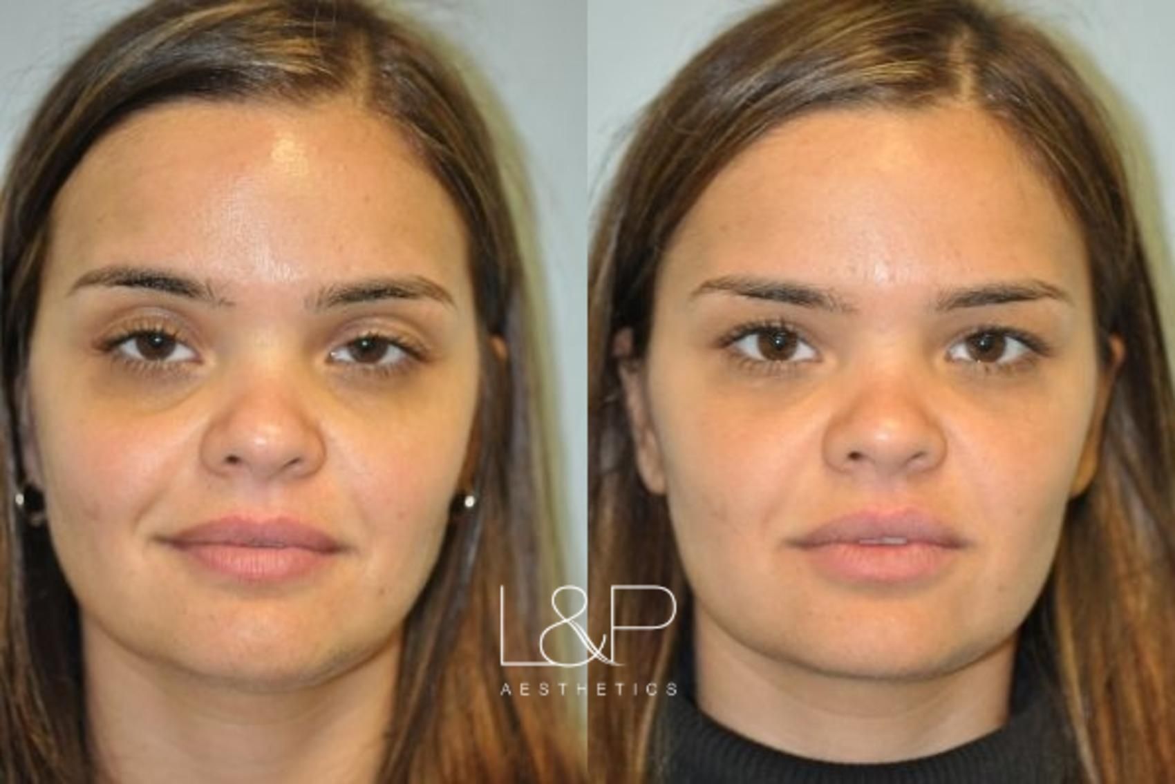 Facial Fillers before and after treatment