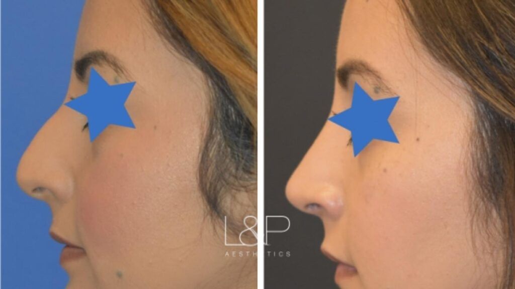 Rhinoplasty before and after treatment in the Bay Area