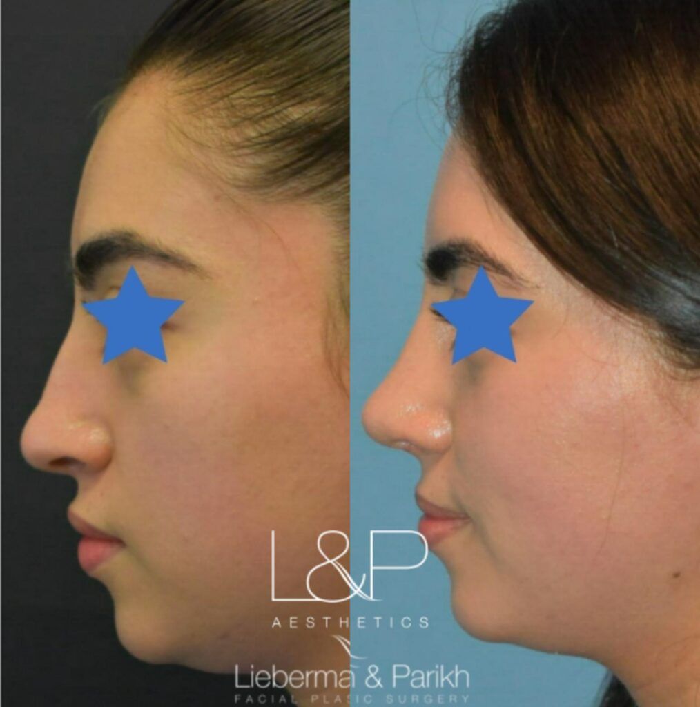 Rhinoplasty before and after treatment in Los Gatos, CA