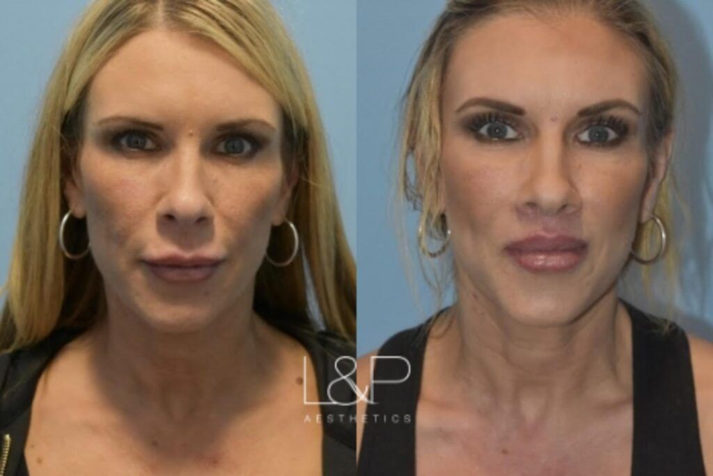 Lip Lift before and after treatment in Palo Alto, California