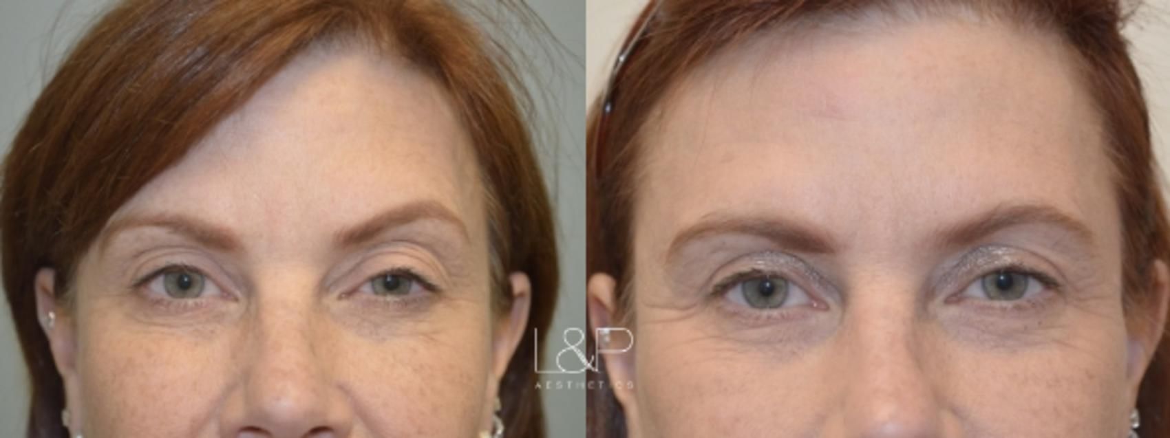 Upper blepharoplasty female patient before and after procedure at L&P Aesthetics