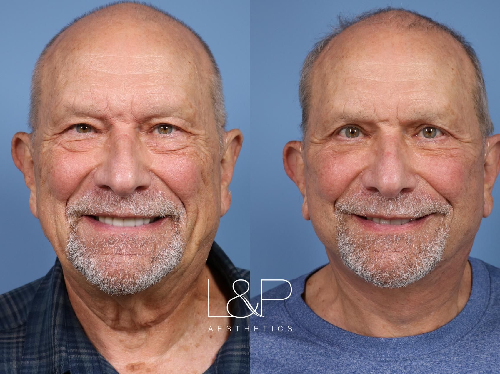 Facelift Neck Lift before and after treatment in Los Gatos, CA
