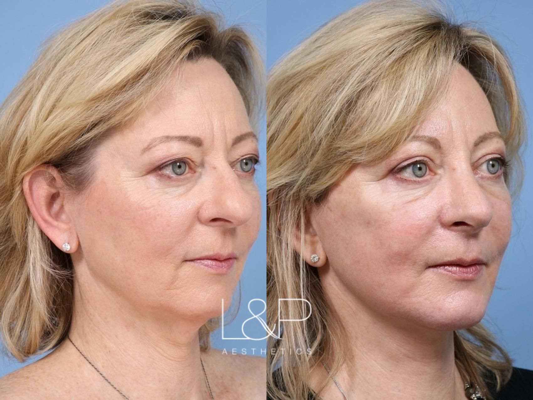 Rhinoplasty & Facelift Neck Lift before and after treatment