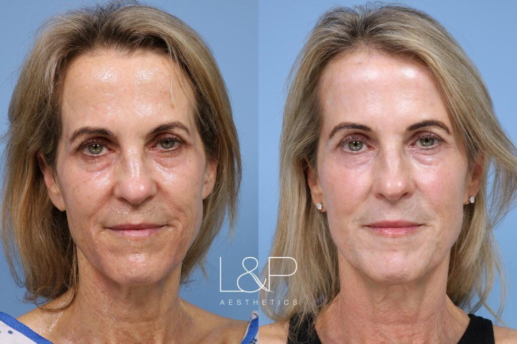 Laser Resurfacing before and after treatment in Los Gatos, California