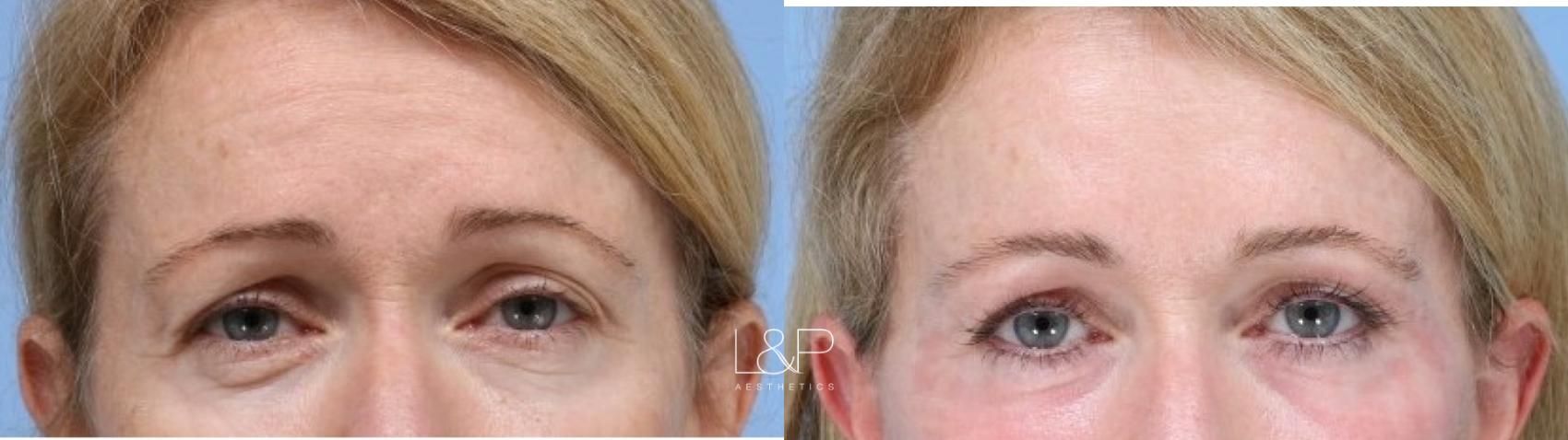 Laser Resurfacing before and after treatment in Palo Alto, CA