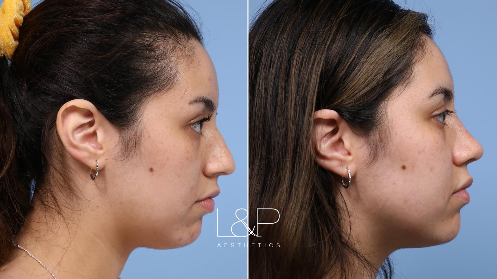 Rhinoplasty before and after treatment in Los Gatos, CA
