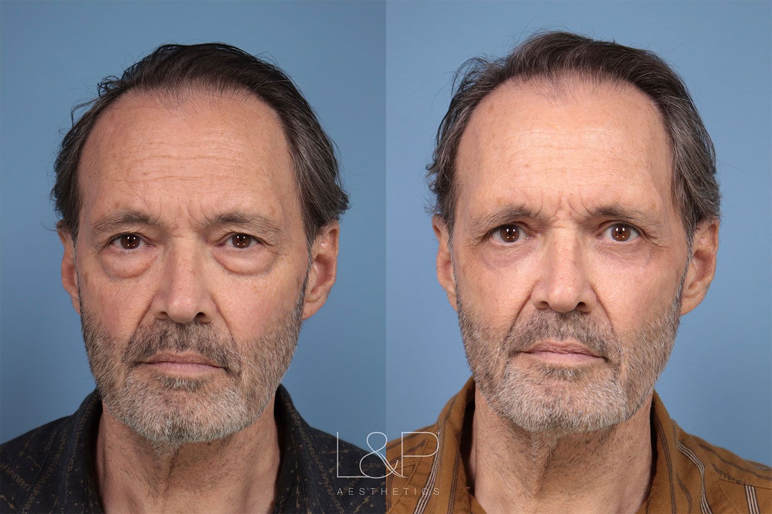 Before and After Male Upper and Lower Blepharoplasty in Palo Alto, CA