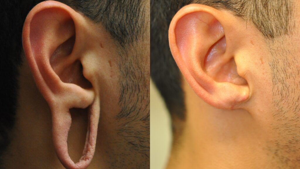 Before/after of loose earlobes